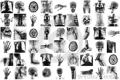 X-ray multiple part of human and many medical condition and disease Stock Photo