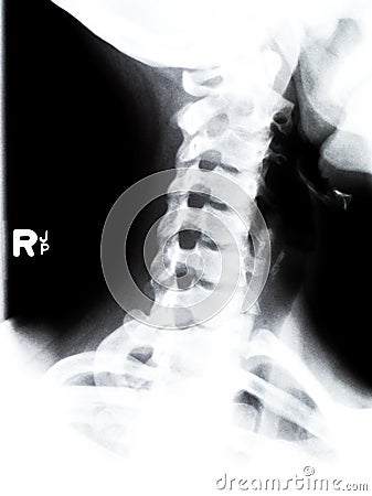 X ray neck and shoulder Stock Photo