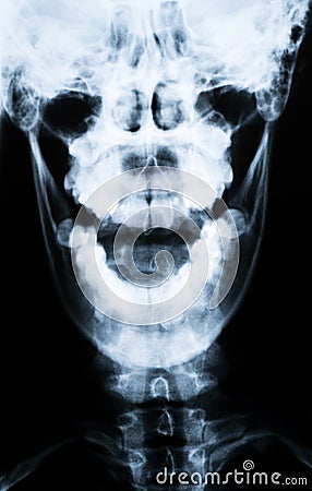 X-ray of the neck and skull - Front view Stock Photo