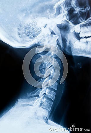 X-ray of the neck and skull - side view Stock Photo