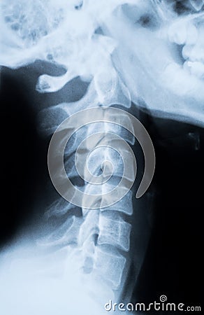 X-ray of the neck and skull - side view Stock Photo