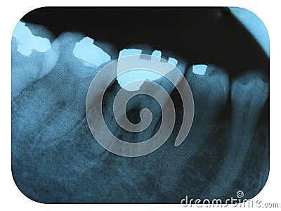 X-Ray Negative Tooth Filling Amalgam Stock Photo