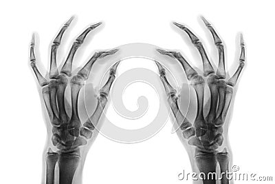 X-ray normal human hands on white background . Oblique view Stock Photo