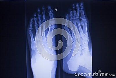 X-ray orthopedics scan of foot injury anterior posterior AP Stock Photo