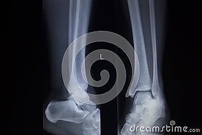 X-ray orthopedics scan of foot injury anterior posterior AP Stock Photo