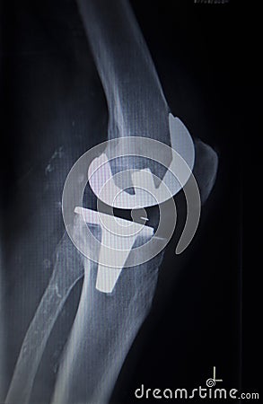 X-ray orthopedics scan of knee meniscus implant prosthetics Stock Photo