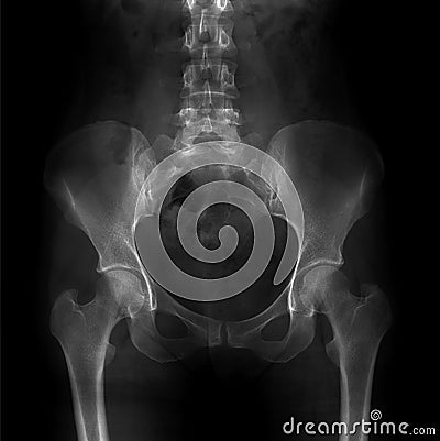 X-ray of the pelvis and the lumbosacral spine. Spina bifida S1. Stock Photo