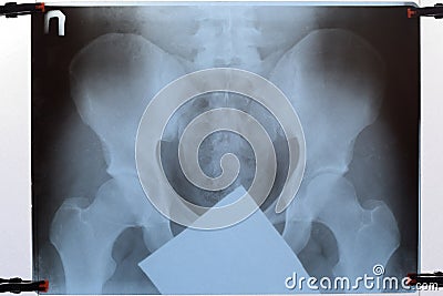X-ray of the pelvis and sacrum. X-ray Stock Photo