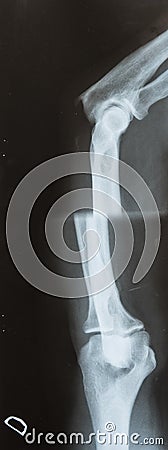 X-ray photo of a human leg with dislocated leg femur Stock Photo