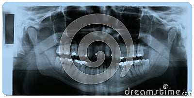 X-ray photo of human teeth Stock Photo