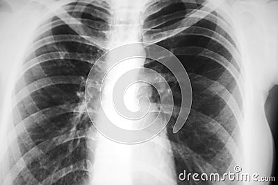 X-ray picture Stock Photo