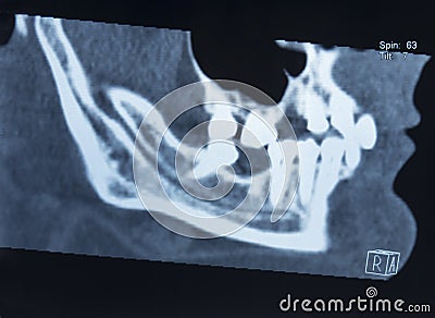 X-ray picture of the female jaw of a man with the absence of several teeth Editorial Stock Photo