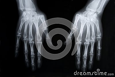 X-ray picture of human hands Stock Photo