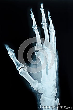 X-ray picture of human hands. Stock Photo