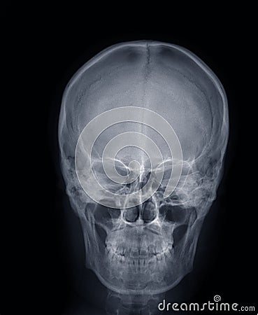 X-ray picture:human head Stock Photo