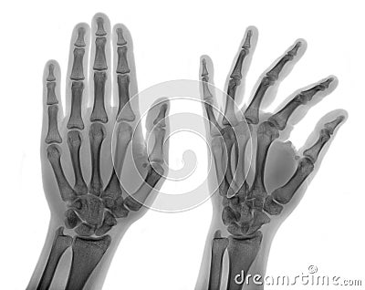 X-ray picture - Human palms Stock Photo