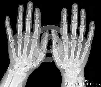X-ray picture - Human palms Stock Photo