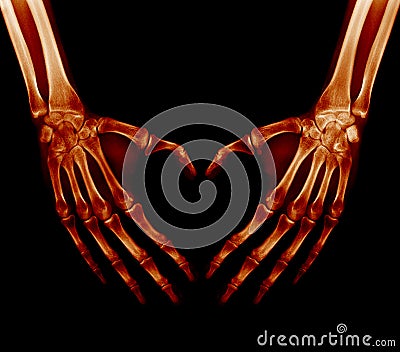 X-ray picture - Human palms Stock Photo