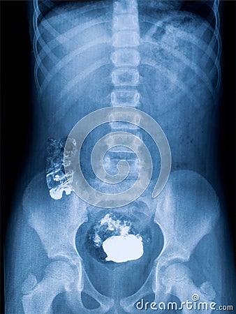 X-ray picture of the intestine with foreign bodies Stock Photo