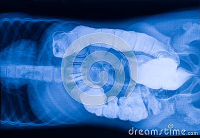 X-ray picture of the intestine with foreign bodies Stock Photo