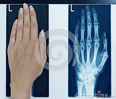 X-ray picture left hand Stock Photo