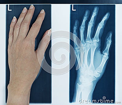 X-ray picture left hand Stock Photo