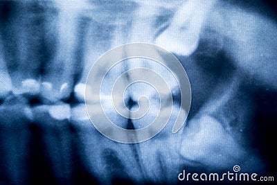 X-Ray of problematic wisdom teeth Stock Photo