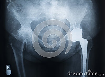 X-ray of the prosthesis of the left hip joint. The right joint is affected by rheumatoid arthritis Stock Photo