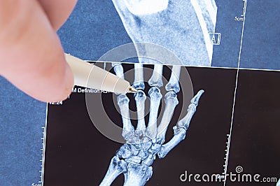X-ray scan of hand, bones and finger joints. Doctor pointed on finger small joints, where pathology is detected, such as arthritis Stock Photo