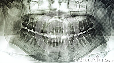 X-Ray scan human for teeth Stock Photo