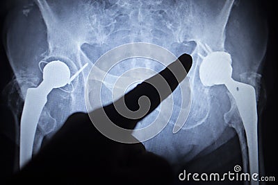 X-ray scan image of hip joint replacement orthopedic implant Stock Photo