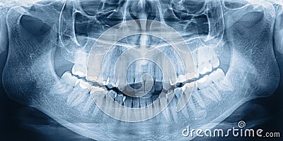 X-ray scan of teeth Stock Photo