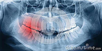 X-ray scan of teeth Stock Photo