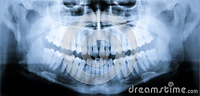 X-ray scan of teeth Stock Photo