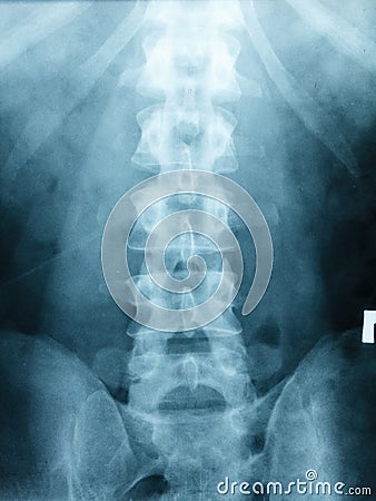 X-ray Scoliosis film x-ray lumbar spine AP Stock Photo