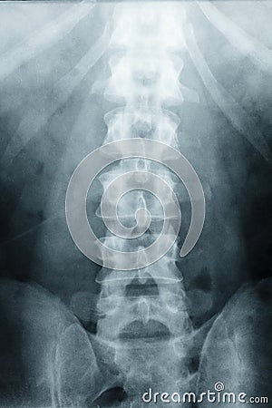 X-ray Scoliosis film x-ray lumbar spine AP Stock Photo