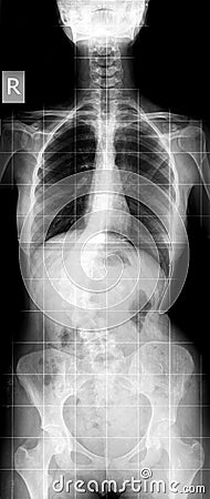 X-ray of scoliosis Stock Photo