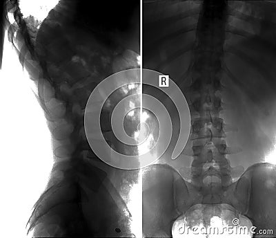 X-ray scoliosis of the lumbar spine. Negative. Stock Photo