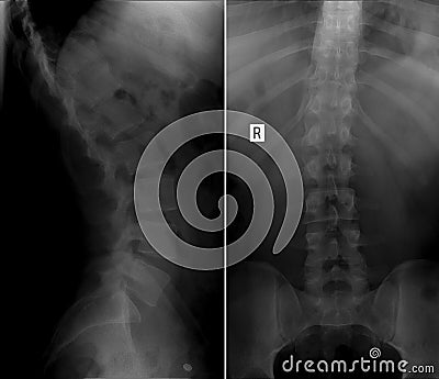X-ray scoliosis of the lumbar spine. Stock Photo