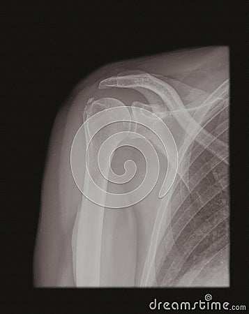 X-ray of a shoulder old style Stock Photo