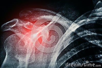 X-ray of shoulder, roentgen picture of human bones of skeleton and red spot as symbol of illness and pain Stock Photo