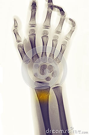 X-ray showing fracture of the distal radius Stock Photo