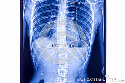 X ray showing scoliosis of the lumbar spine Stock Photo