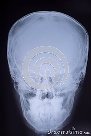 X-ray of the skull bones in direct projection Stock Photo