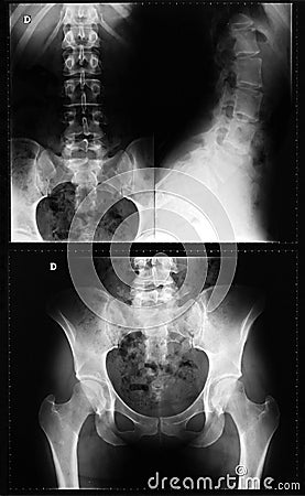 X-ray of the spinal column Stock Photo