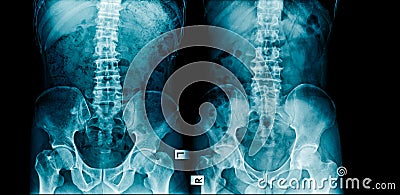 X-ray spine and pelvis Stock Photo