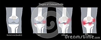Arthritis in knee joint Vector Illustration