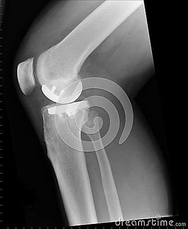 X ray of a unilateral knee replacement Stock Photo