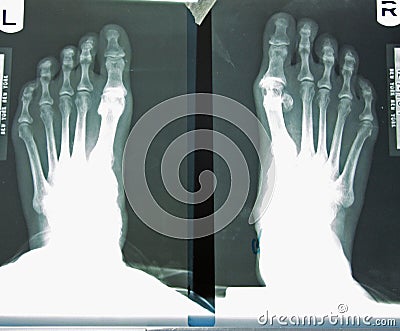 X-ray Of Woman's Foot Stock Photo