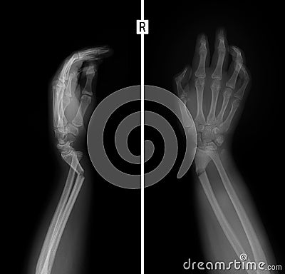 X-ray of the wrist. Greenstick fracture of the radius. Stock Photo